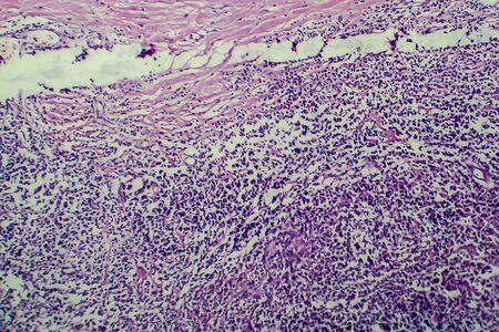 Hodgkins lymphoma, light micrograph, photo under microscopeの写真素材