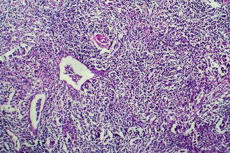 Hodgkins lymphoma, light micrograph, photo under microscopeの写真素材