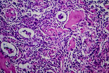 Hodgkins lymphoma, light micrograph, photo under microscopeの写真素材