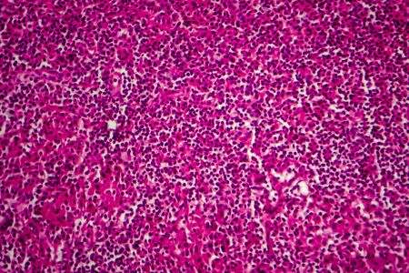 Non-Hodgkins lymphoma, light micrograph, photo under microscopeの写真素材