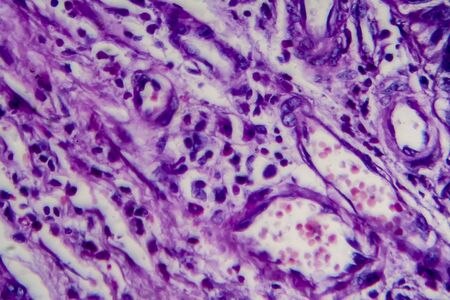 Bladder transitional cell carcinoma, light micrograph, photo under microscope. High magnificationの写真素材