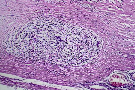 Hodgkins lymphoma, light micrograph, photo under microscopeの写真素材