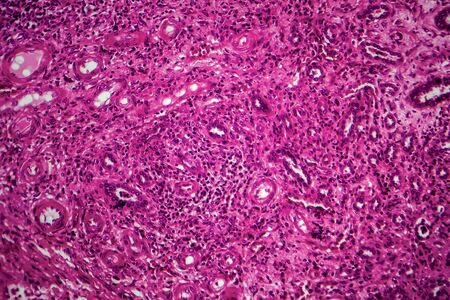 Renal tuberculosis, light micrograph, photo under microscopeの写真素材