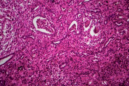 Renal tuberculosis, light micrograph, photo under microscopeの写真素材