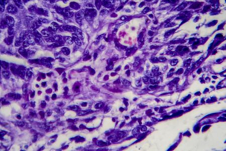 Bladder transitional cell carcinoma, light micrograph, photo under microscope. High magnificationの写真素材