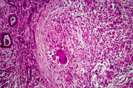 Renal tuberculosis, light micrograph, photo under microscopeの写真素材