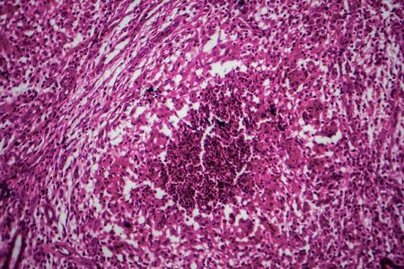 Renal tuberculosis, light micrograph, photo under microscopeの写真素材