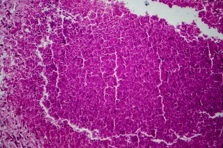 Renal tuberculosis, light micrograph, photo under microscopeの写真素材