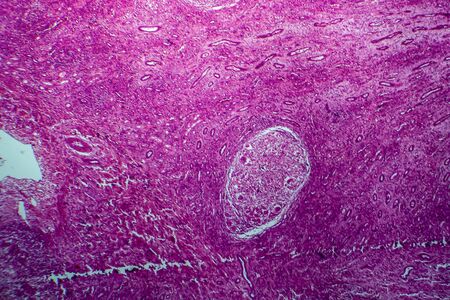 Renal tuberculosis, light micrograph, photo under microscopeの写真素材
