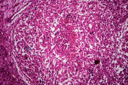 Renal tuberculosis, light micrograph, photo under microscopeの写真素材