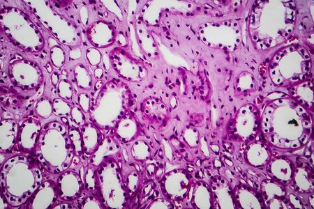 Tubular atrophy, light micrograph, photo under microscopeの写真素材