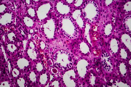 Tubular atrophy, light micrograph, photo under microscopeの写真素材