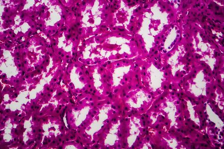 Tubular atrophy, light micrograph, photo under microscope. High magnificationの写真素材