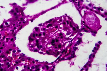 Tubular atrophy, light micrograph, photo under microscope. High magnification