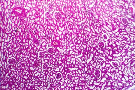 Tubular atrophy, light micrograph, photo under microscopeの写真素材