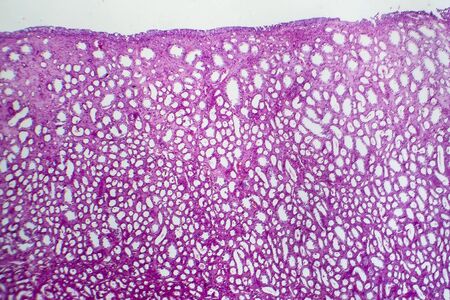 Tubular atrophy, light micrograph, photo under microscopeの写真素材