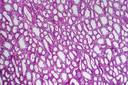 Tubular atrophy, light micrograph, photo under microscopeの写真素材
