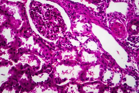 Tubular atrophy, light micrograph, photo under microscope. High magnificationの写真素材
