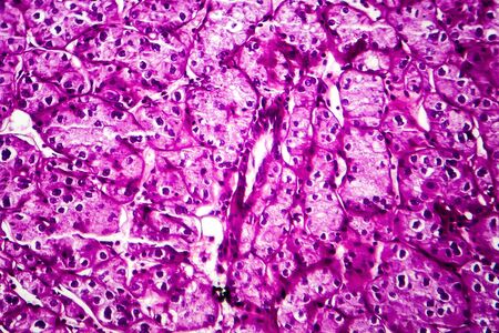 Kidney cancer, light micrograph, photo under microscopeの写真素材