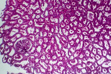 Tubular atrophy, light micrograph, photo under microscopeの写真素材