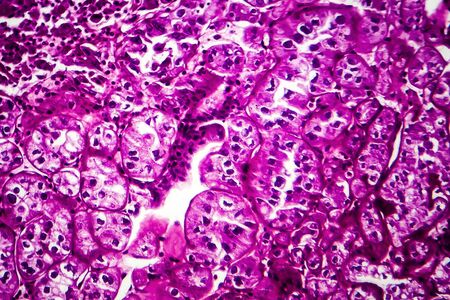 Kidney cancer, light micrograph, photo under microscopeの写真素材