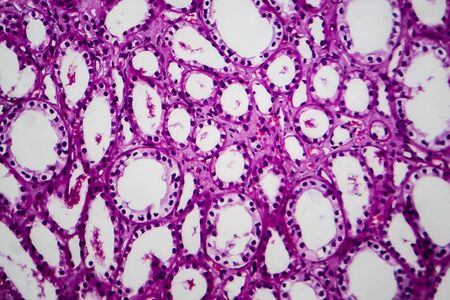 Tubular atrophy, light micrograph, photo under microscopeの写真素材