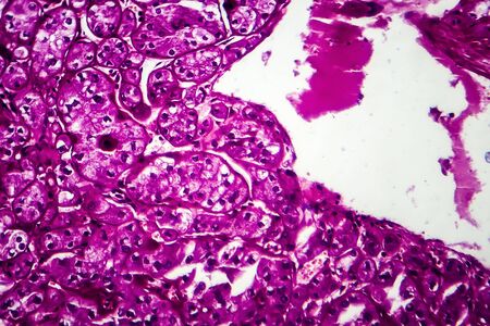 Kidney cancer, light micrograph, photo under microscopeの写真素材