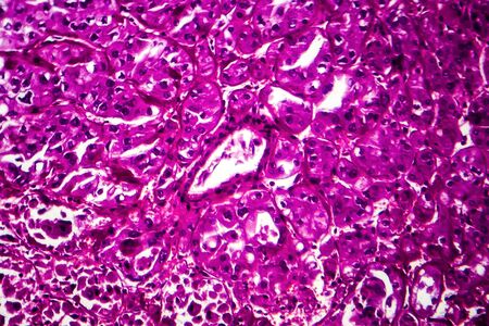 Kidney cancer, light micrograph, photo under microscopeの写真素材
