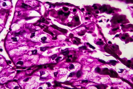 Kidney cancer, light micrograph, photo under microscope. High magnificationの写真素材