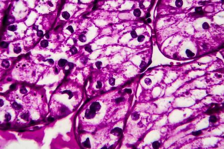Kidney cancer, light micrograph, photo under microscope. High magnificationの写真素材