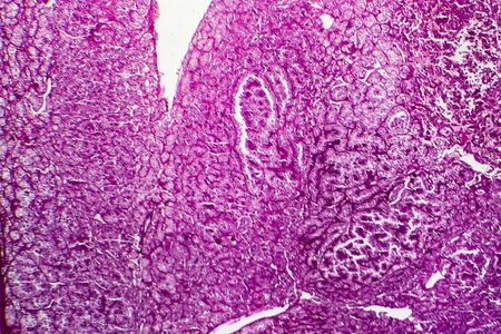 Kidney cancer, light micrograph, photo under microscopeの写真素材