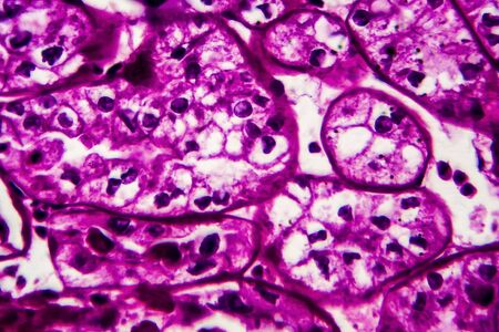 Kidney cancer, light micrograph, photo under microscope. High magnificationの写真素材