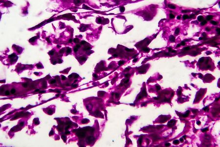 Kidney cancer, light micrograph, photo under microscope. High magnification