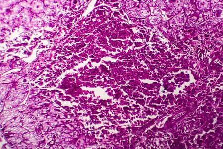 Kidney cancer, light micrograph, photo under microscopeの写真素材