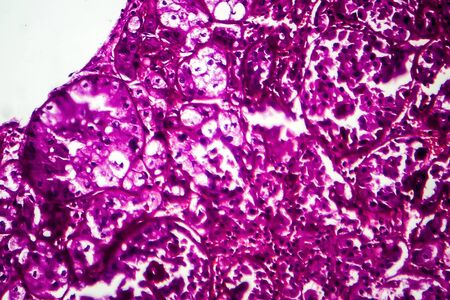 Kidney cancer, light micrograph, photo under microscopeの写真素材