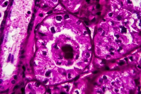 Kidney cancer, light micrograph, photo under microscope. High magnificationの写真素材