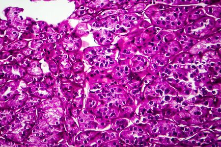 Kidney cancer, light micrograph, photo under microscope