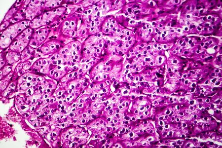 Kidney cancer, light micrograph, photo under microscopeの写真素材
