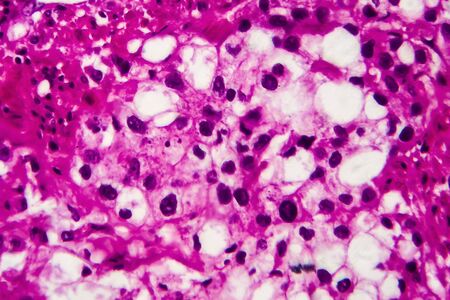 Bladder cancer, light micrograph, photo under microscope. High magnificationの写真素材