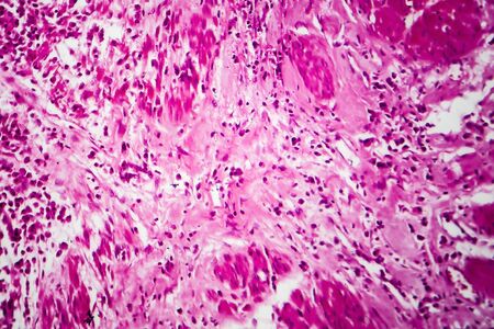 Bladder cancer, light micrograph, photo under microscopeの写真素材