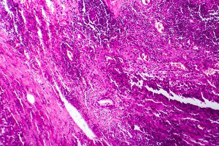 Bladder cancer, light micrograph, photo under microscopeの写真素材