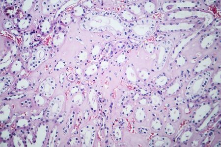 Histopathology of hypertensive renal disease, light micrograph, photo under microscopeの写真素材