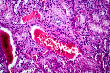 Histopathology of hypertensive renal disease, light micrograph, photo under microscopeの写真素材