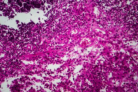 Bladder cancer, light micrograph, photo under microscope