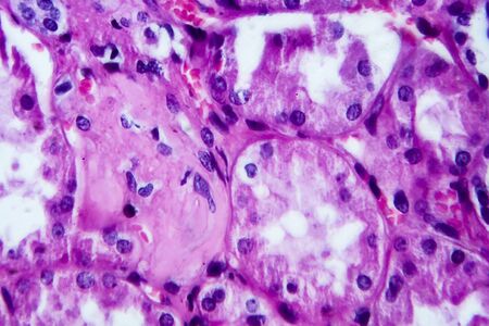 Histopathology of hypertensive renal disease, light micrograph, photo under microscope. High...