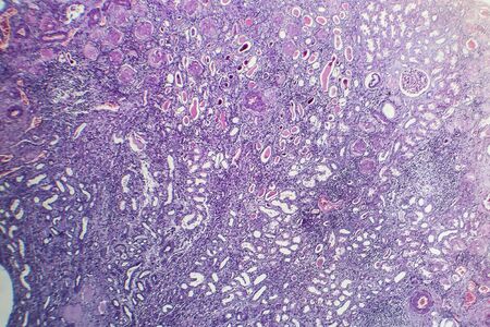 Chronic nephritis, light micrograph, photo under microscopeの写真素材
