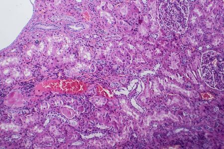 Histopathology of hypertensive renal disease, light micrograph, photo under microscopeの写真素材
