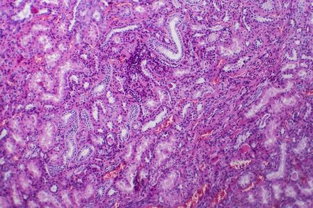 Histopathology of hypertensive renal disease, light micrograph, photo under microscopeの写真素材