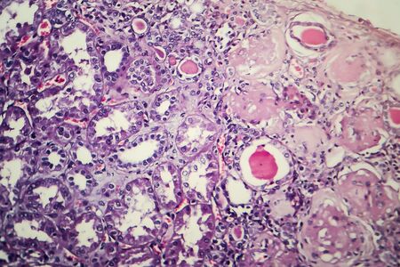 Chronic nephritis, light micrograph, photo under microscopeの写真素材