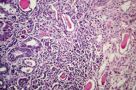 Chronic nephritis, light micrograph, photo under microscope